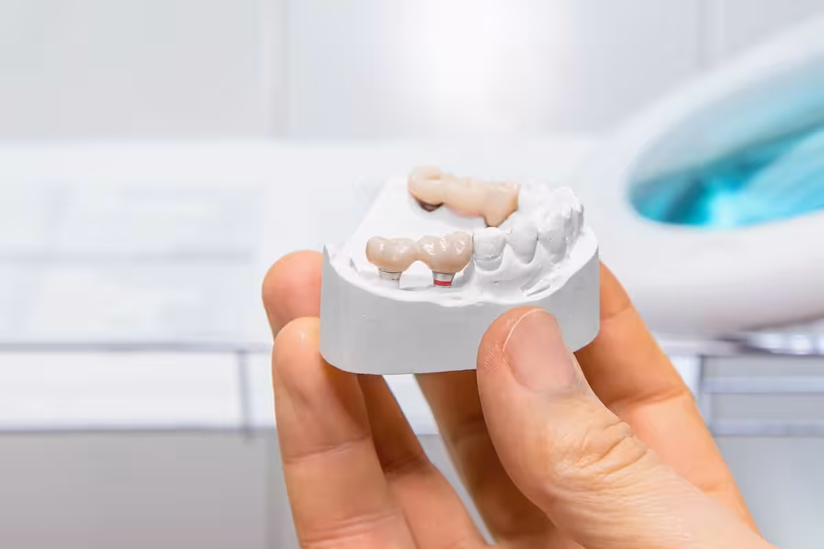 How Should A Dental Bridge Fit Blog.jpg
