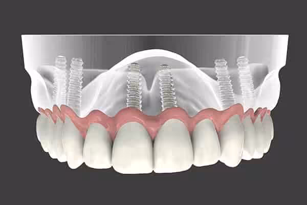 Implant Supported Dentures Image
