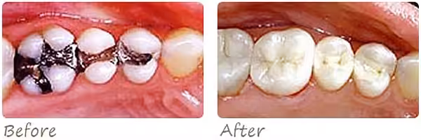 Before After Crowns Inlays Photo
