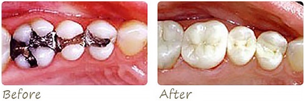 before and after photo of inlay crowns