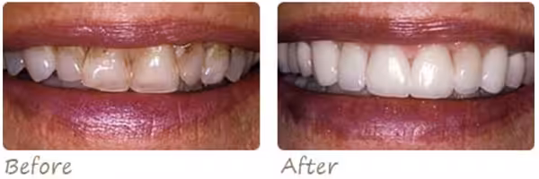 Before After Crowns Photo