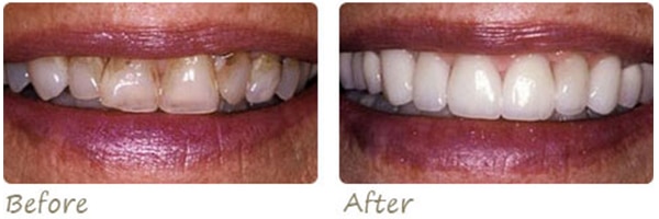 before and after photo of woman's smile after dental work