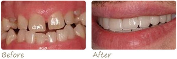 before and after photo of teeth after crowns