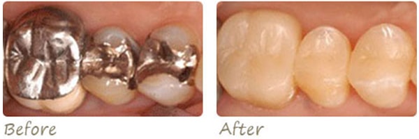 before and after photo of three teeth after crowns