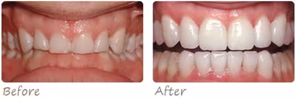 Before After Gumlift Photo
