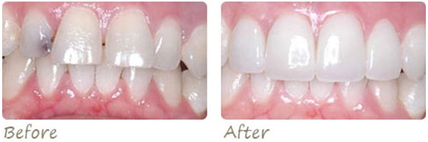 before and after photos of dental patient's teeth