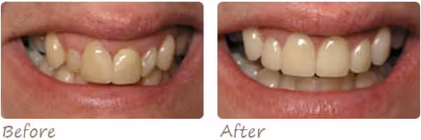 Before After Veneers Crowns2 Photo