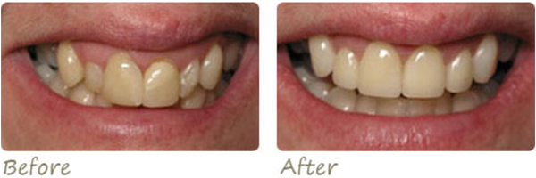 before and after photo of dental procedures