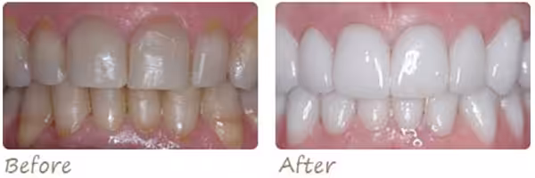 Before After Veneers Photo