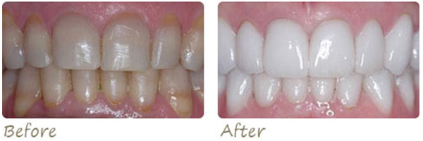 before and after photos of dental teeth