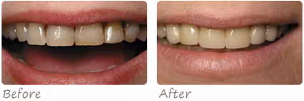 Before After Veneers2 Photo