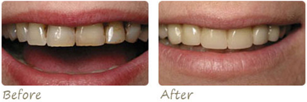 before and after photo of veneers