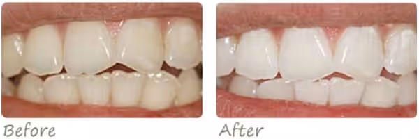 Before After Whitening Photo