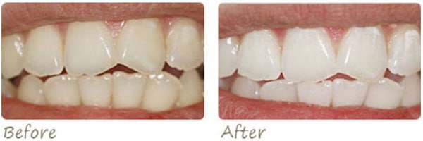 before and after photos of teeth whitening