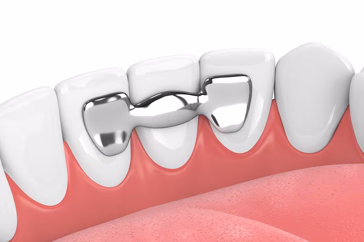 Can A Dental Bridge Be Removed And Recemented Blog.jpg