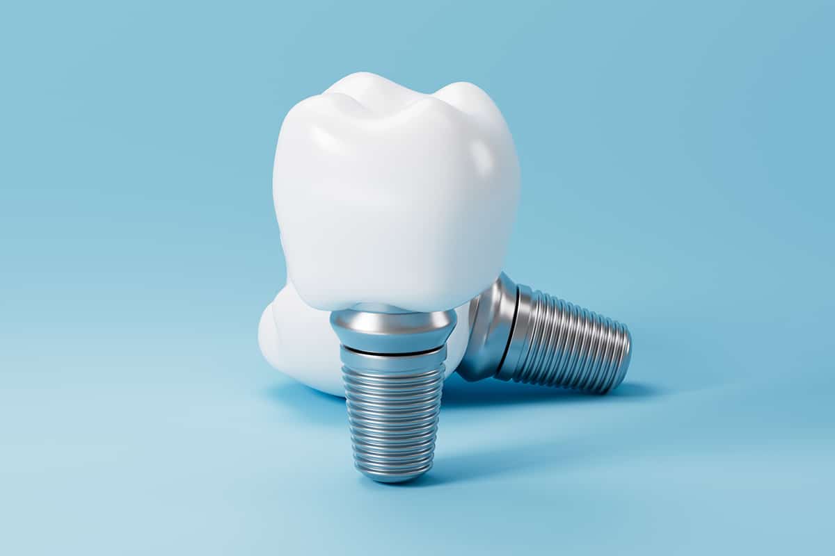 Can you get dental implants years after losing a tooth blog