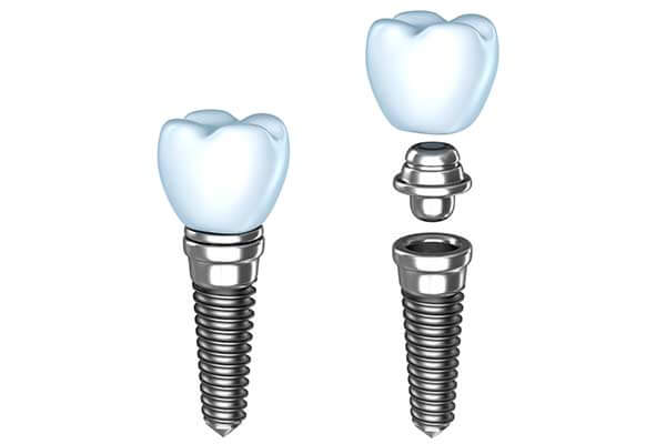 Single Tooth Dental Implants illustration