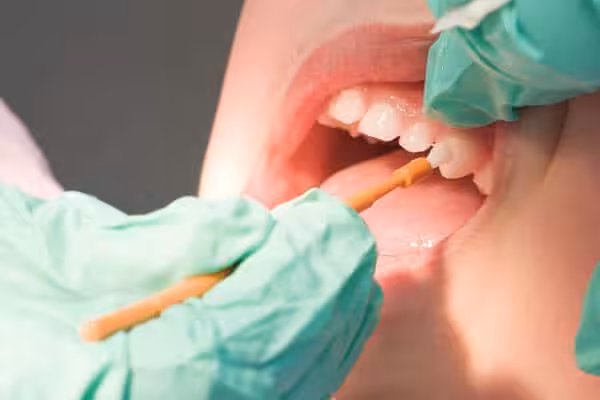 Fluoride Treatment Images