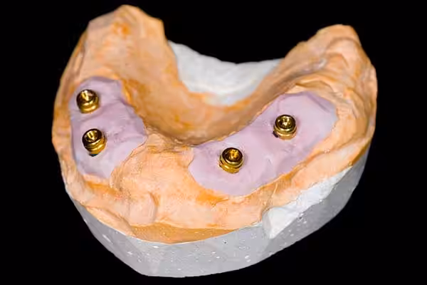 Full Arch On 4 Implants Image