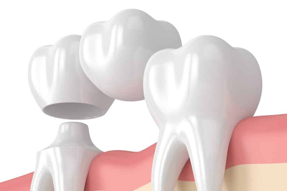 How Long Do Dental Bridges Last?