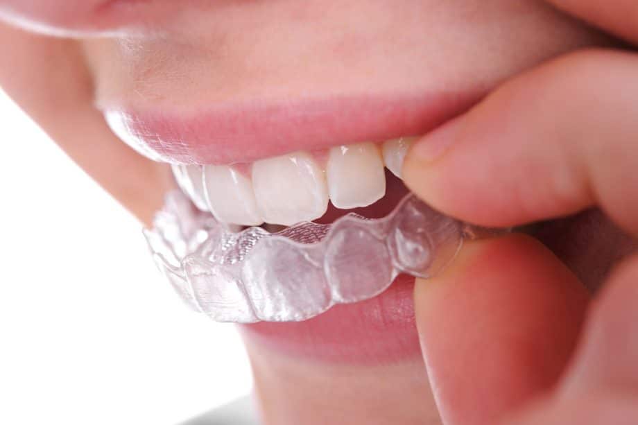 woman putting invisalign retainer on her teeth