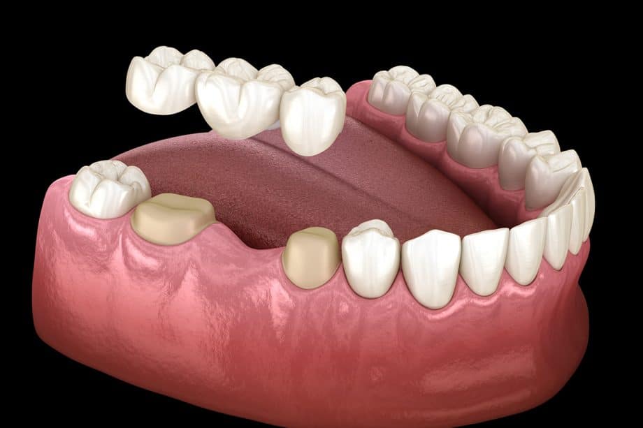 How Long Does It Take For A Dental Bridge To Settle?