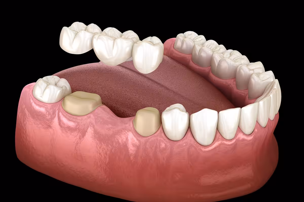 How Long Does It Take For A Dental Bridge To Settle Blog.jpg