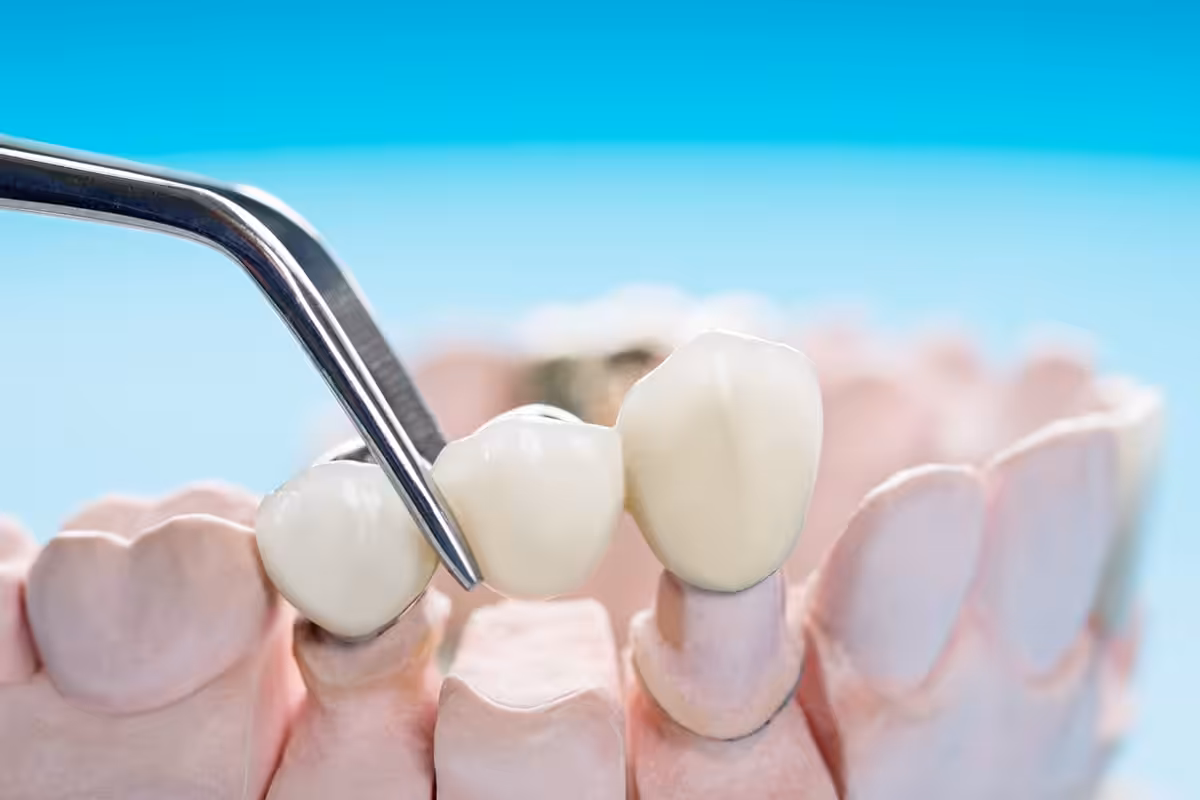 How Much Does A Dental Bridge Cost In Aliso Viejo Ca Blog.jpg