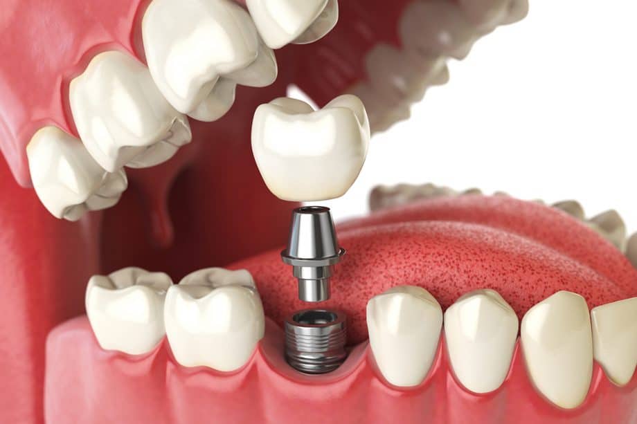 model of a mouth with a single tooth dental implant