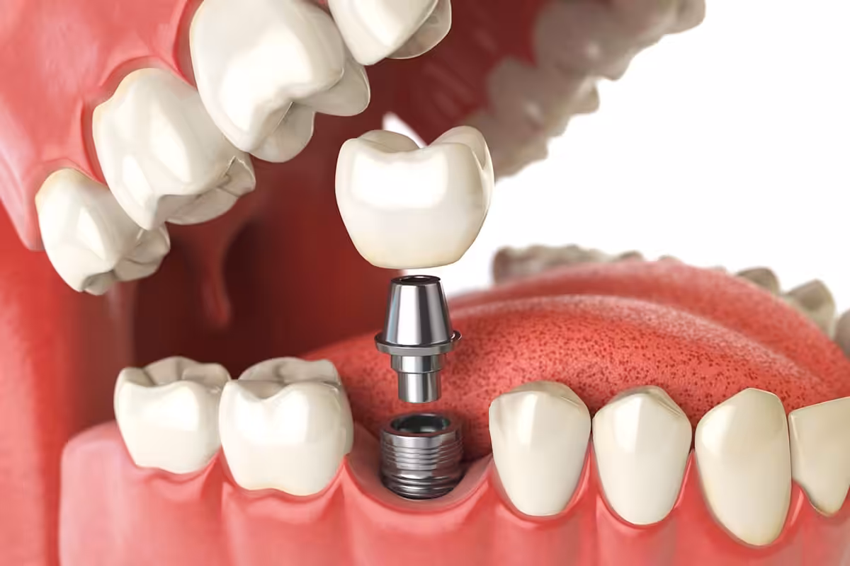 How Much Does A Dental Implant Cost In Aliso Viejo Ca.jpg
