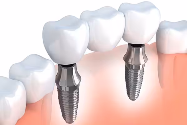 Implant Supported Bridge Image