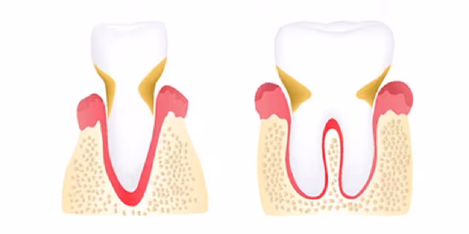 Moderate Periodontitis Stage