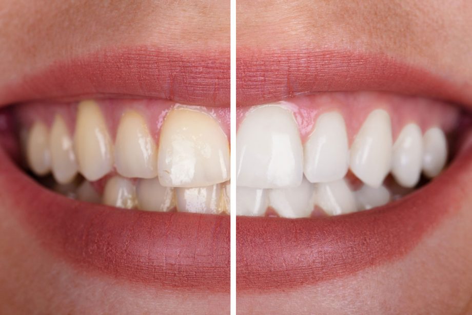 split photo of woman's smile - before and after whitening