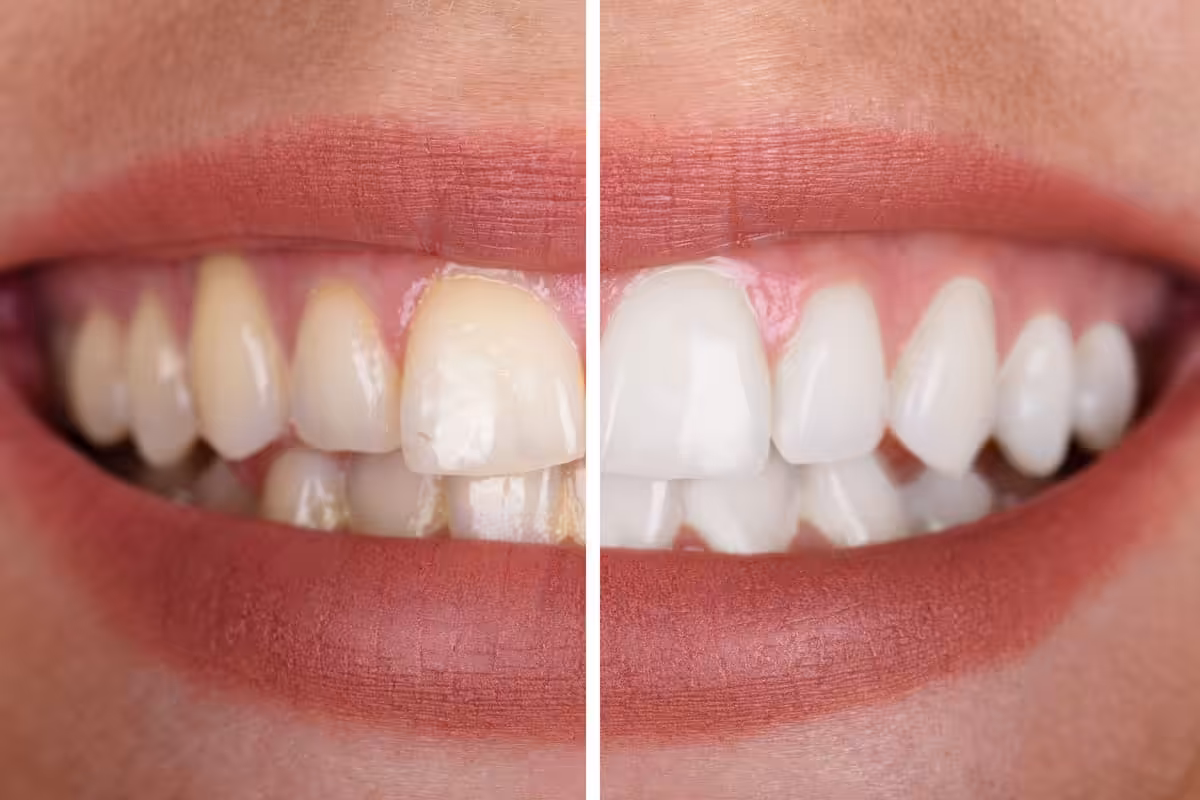 Teeth Whitening Before After.jpg