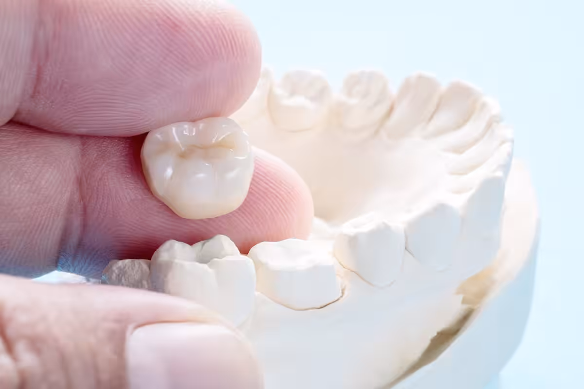 What Are The Benefits Of Cerec Crowns Blog.jpg